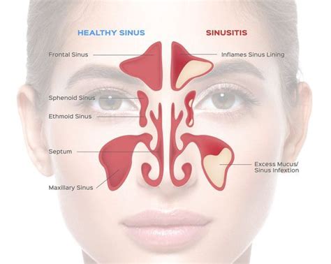 nose - CHRONIC MAXILLARY SINUSITIS - Dr. Meenesh Juvekar - ENT Specialist