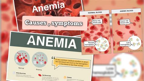 Anaemia Causes Signs And Symptoms Anemia Signs And Symptoms YouTube