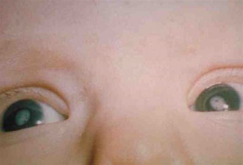 Congenital Cataract Types Causes Features Treatment Dnb Pediatrics