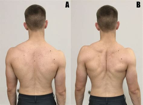 Figure 1 From Current Views Of Scapular Dyskinesis And Its Possible