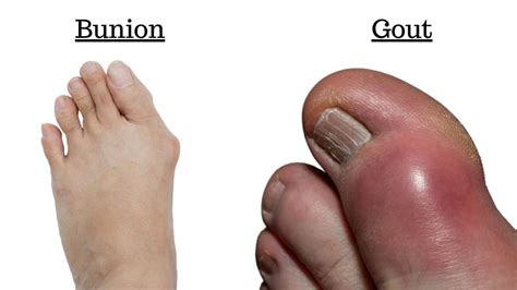 Corn Vs Bunion Bunion Vs Callus Causes Of Big Toe Pain