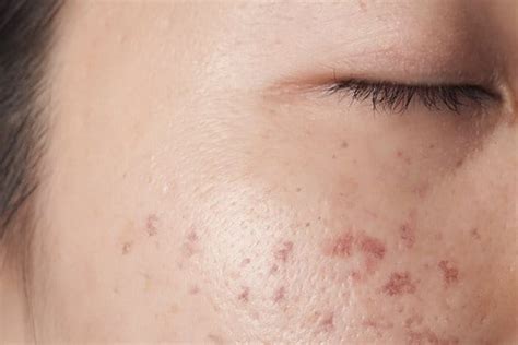 Post Inflammatory Hyperpigmentation Pih Eucerin