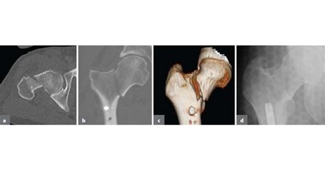 Overview Management Of Occult Femoral Neck Fracture In High Energy