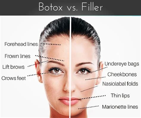 Where Should I Get Botox And Where Should I Get Fillers This Cheat Sheet Gives You A Guideline