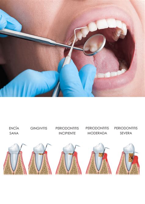 Cirug A Periodontal Custom Dental Cl Nica En Barcelona