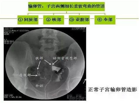 【科普小课堂】未避孕1年内未孕，应积极做输卵管造影检查 好大夫在线