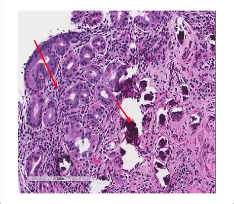 Hematoxylin And Eosin Stain 200× Prominent Cyanophilic Calcium