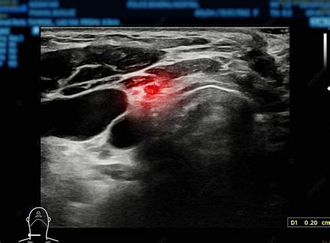 Thyroid Gland Diagnostics Using Ultrasonography Imagery Checkup Us