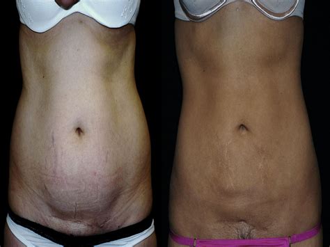 Abdominoplasty Tummy Tuck Sadove Cosmetic Surgery