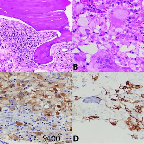 A And B Bone Marrow Biopsy With Multifocal Lesions Composed Of