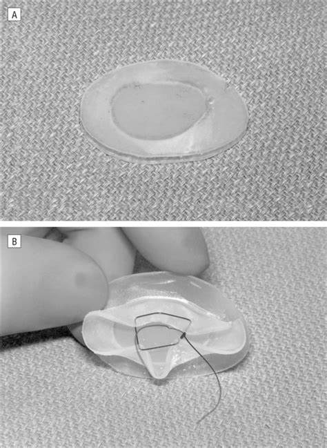 Computed Tomography For Constructing Custom Nasal Septal Buttons