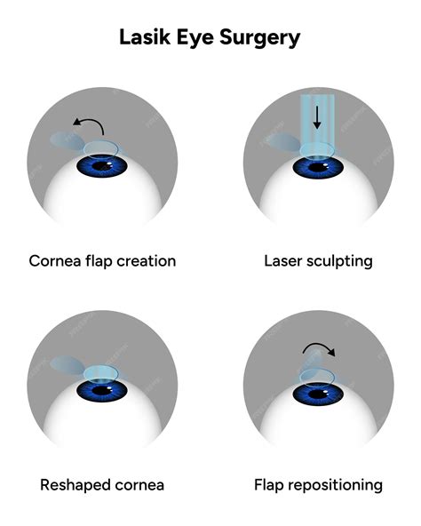 Procedimiento De Las Etapas De La Cirugía Ocular Lasik Vector Premium