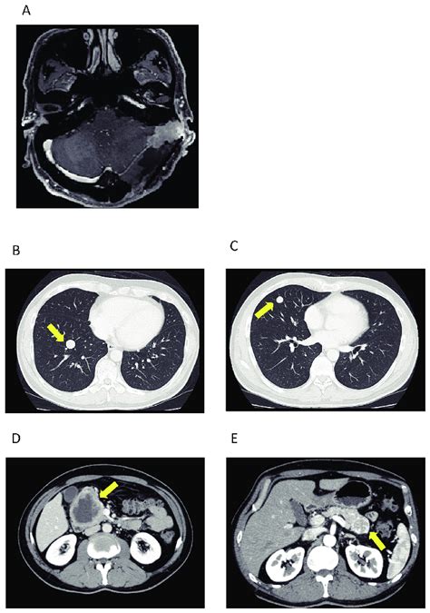 Case 1 Fig. 1A: Magnetic resonance imaging (MRI) of brain tumor at ...