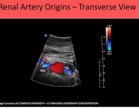 Abdomen Vasc Renal Vessels Flashcards Quizlet