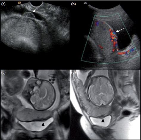 Placenta Praevia With Morbidly Adherent Placenta A B Transvaginal