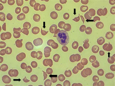 Microangiopathic hemolytic anemia - Dermatology Advisor