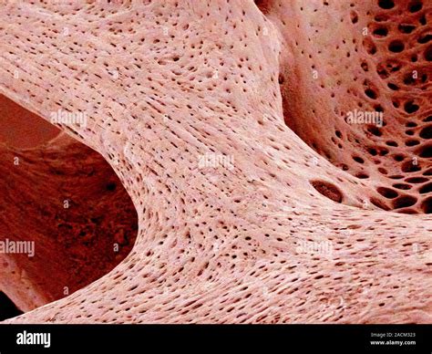 Bone Tissue Coloured Scanning Electron Micrograph Sem Of Cancellous