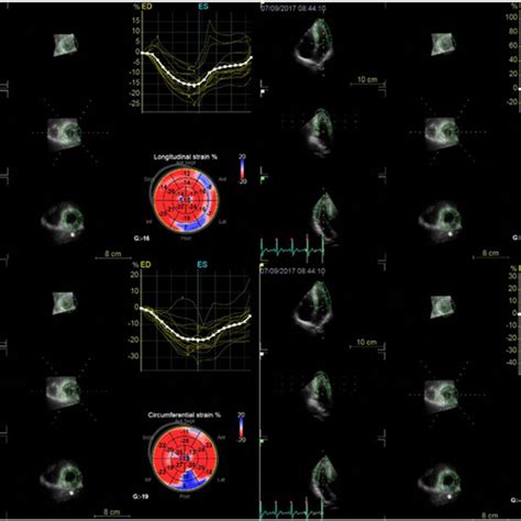 Three Dimensional Speckle Tracking Imaging Of The Left Ventricle