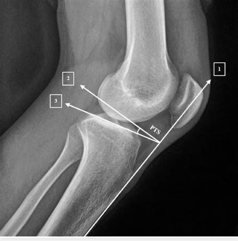 Pts Measurement Using The Anterior Tibial Cortex Method Pts Posterior