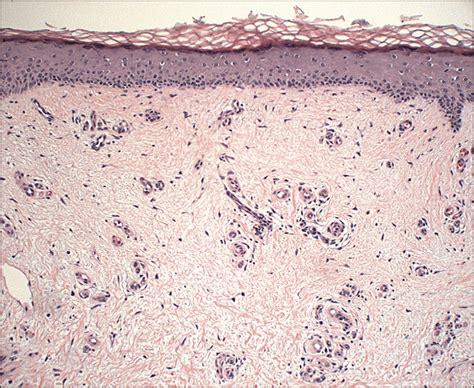 Erythematous Plaques Involving Calves—quiz Case Endocrinology Jama Dermatology The Jama