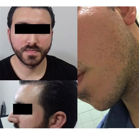 Beard Transplant In Istanbul Turkey Best Clinics Surgeons And Costs