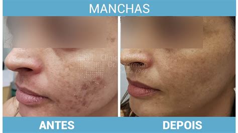 Tratamento Para Manchas Na Pele Cl Nica De Pele