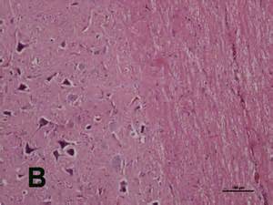 Intramedullary Spinal Cord Glioma Following Microinjection Of