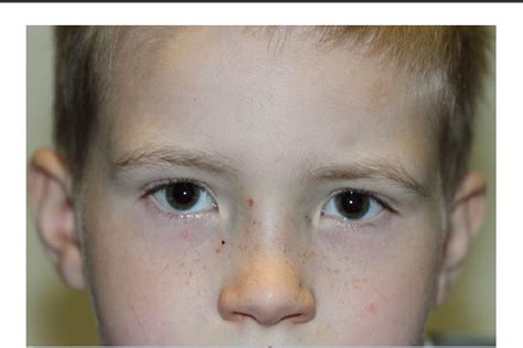 Figure 1 From The Emerging Ophthalmic Phenotype Of Xxyy Syndrome