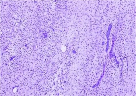 What is Ameloblastic Fibroma? - Pathosomes