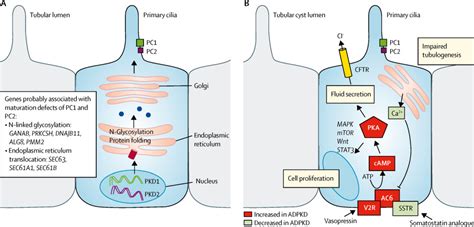 Autosomal Dominant Polycystic Kidney Disease The Lancet