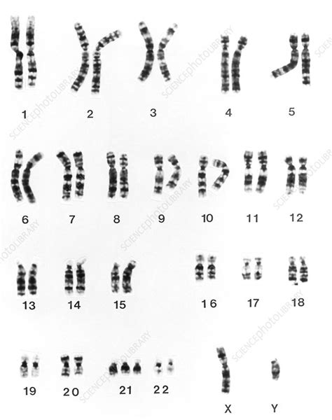 Karyotype of chromosomes in Down's syndrome - Stock Image M352/0002 ...