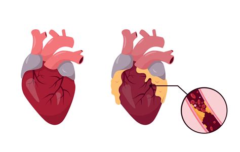 Healthy And Unhealthy Human Heart Ischemic Disease Blocked Coronary