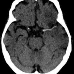 ¡Órale! 24+ Raras razones para el A. Cerebri Media? Encephali media ...