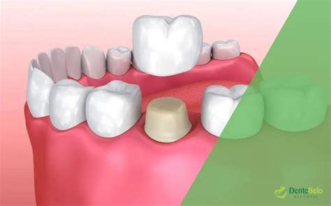 Quanto Custa Uma Coroa Dent Ria Valores Na Dentebelo