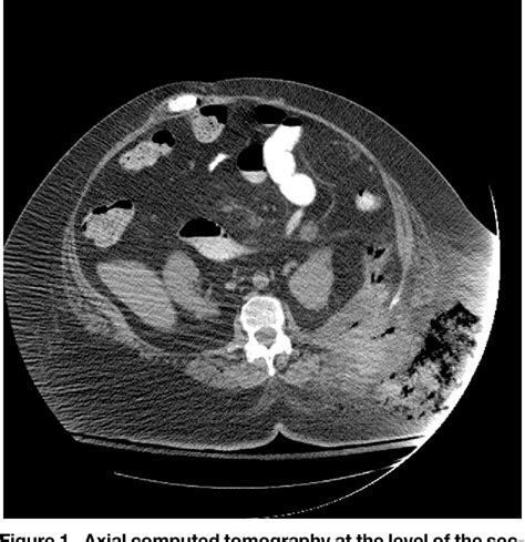 Figure 1 From Retroperitoneal And Cutaneous Necrotizing Fasciitis Secondary To Necrotizing