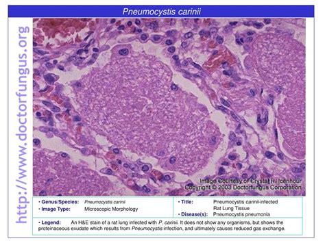 Ppt Pneumocystis Carinii Powerpoint Presentation Free Download Id6693306