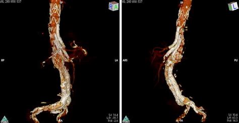 Endovascular Repair Of A Type 1a Endoleak After Ch Evar With A B Evar