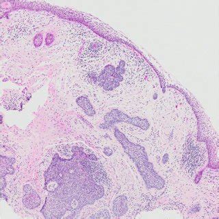 A Panoramic View Shows A Unicystic Ameloblastoma Presenting As A