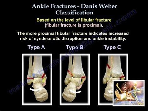 Ankle Fractures Danis Weber Classification - Everything You Need To ...