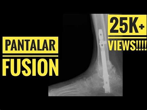 Tibiotalocalcaneal TTC Arthrodesis Pantalar Fusion YouTube