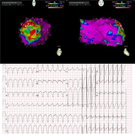 Cardiac Stereotactic Radiotherapy For Refractory Ventricular