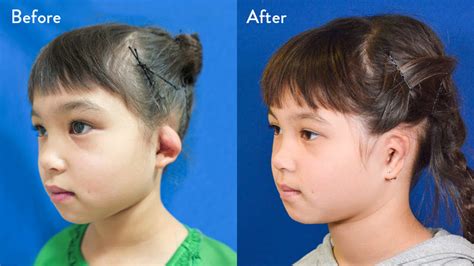 Year Old Female With Left Grade Microtia Before And After Rib