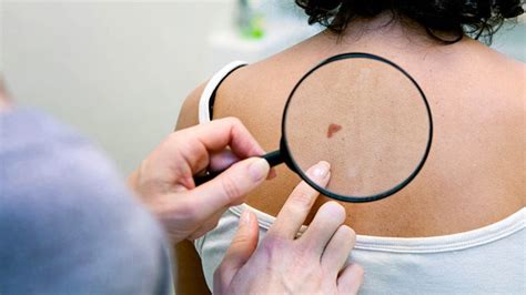 Waiting Even a Month to Remove Melanoma Can Be Deadly | Everyday Health