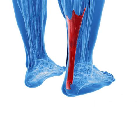 How To Manage An Achilles Tendon Rupture Sport And Spinal Physiotherapy