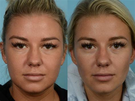 Buccal Fat Removal Before After Photo Gallery Chicago IL TLKM