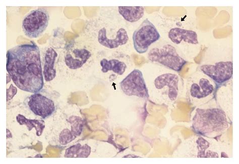 Perinatal Transmission Of The Agent Of Human Granulocytic Ehrlichiosis