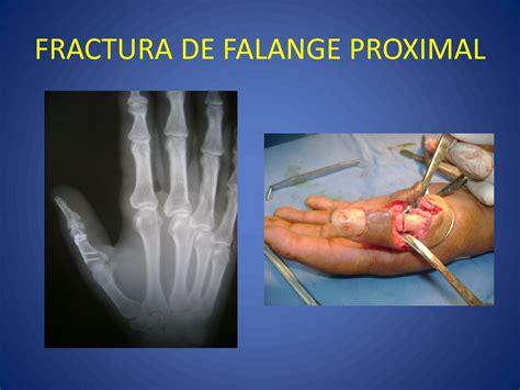 Solution Fractura De Falange Proximal Studypool