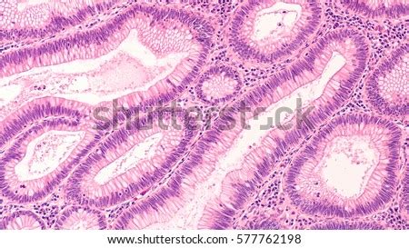 Microscopic Image Tubular Adenoma Adenomas Premalignant Stock Photo 577762198 - Shutterstock