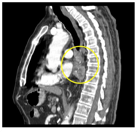 Sagittal Contrast Enhanced Computed Tomography CT Chest Soft Tissue