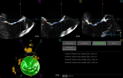 Mitral Valve Coaptation Reserve Index A Model To Localize Individual